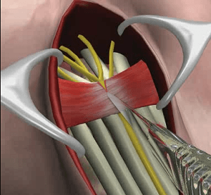 Carpal Tunnel Release Surgery