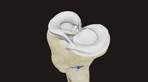 Meniscus Debridement