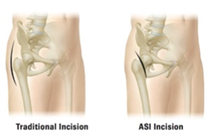 Muscle Sparing Anterior Hip Replacement